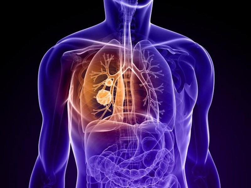 400 ljudi godišnje oboli od raka pluća na jugoistoku Srbije