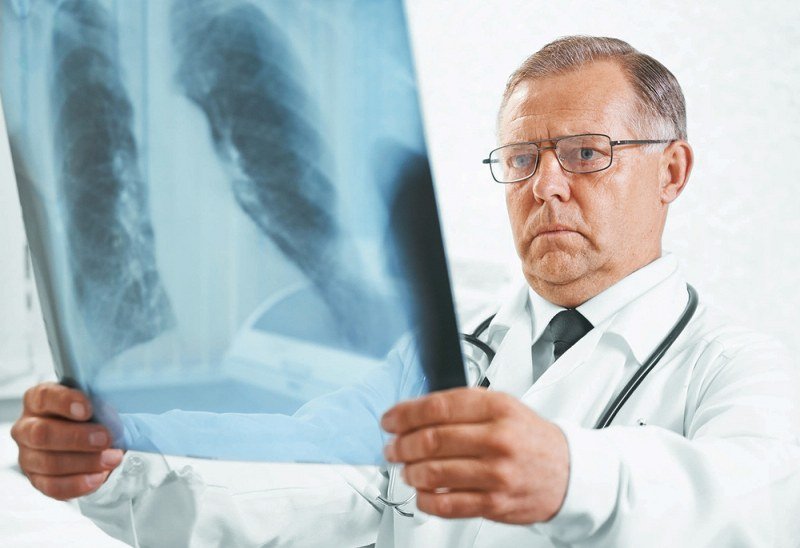Otkrivena nova vrsta raka pluća, nema veze sa pušenjem - Stopa smrtnosti puno veća