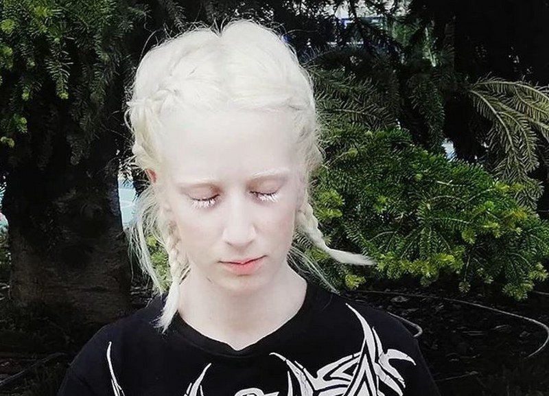 Sudbina - Svetlana ima albinizam, slijepa je od rođenja 
